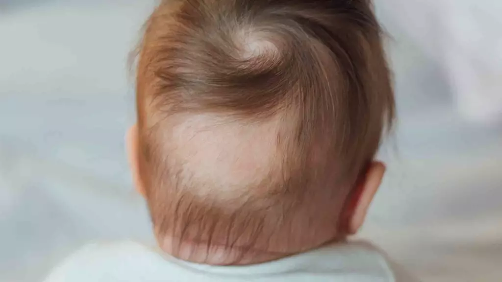 Rambut Bayi alopecia aerata