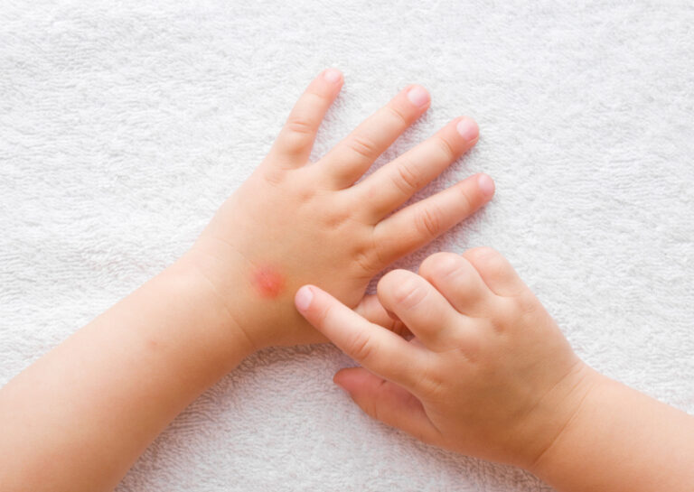 obat gatal digigit nyamuk