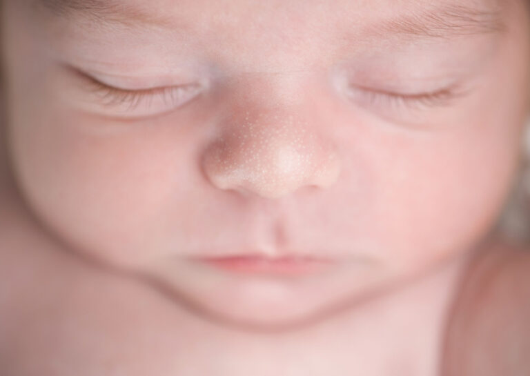 Cari tahu informasi lengkap mengenai bercak putih pada kulit bayi di sini!