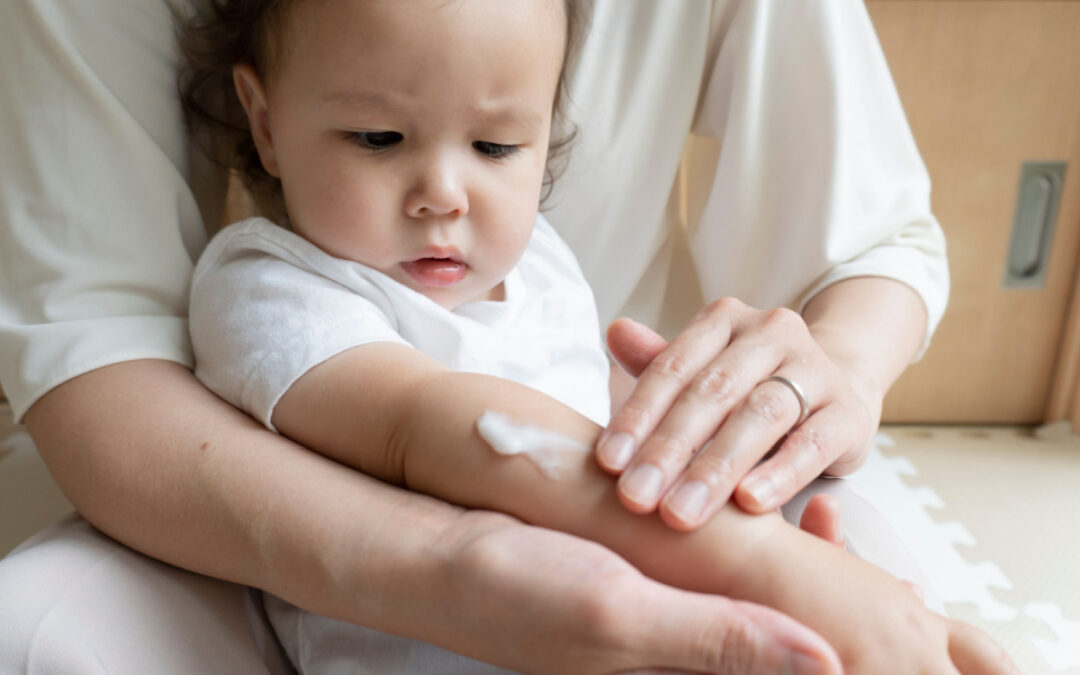 7 Cara Meredakan Kulit Gatal Bayi yang Wajib Diketahui