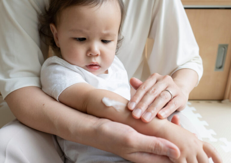 7 Cara Meredakan Kulit Gatal Bayi yang Wajib Diketahui