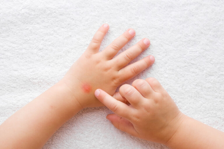 cara menghilangkan gatal