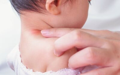 Biduran pada Bayi: Penyebab, Gejala, dan Cara Mengatasinya