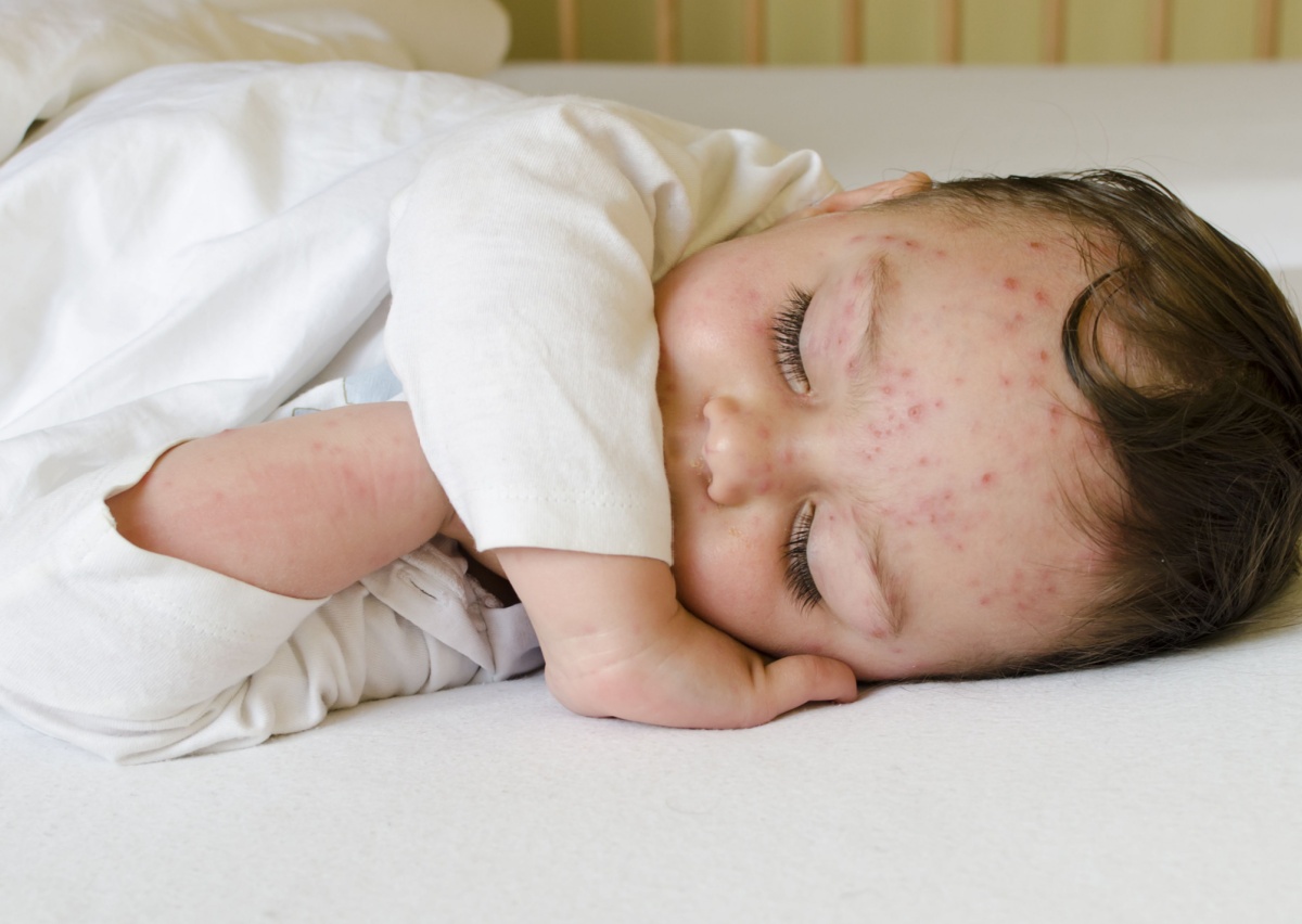 05. Cacar Air pada Bayi_ Penyebab, Ciri-Ciri, dan Cara Mengatasinya