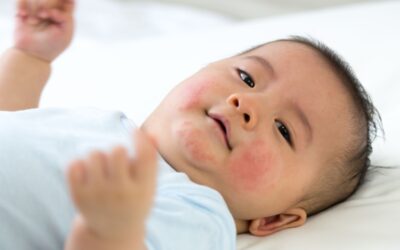 Bruntusan pada Bayi: Penyebab, Ciri-Ciri, dan Cara Mencegahnya